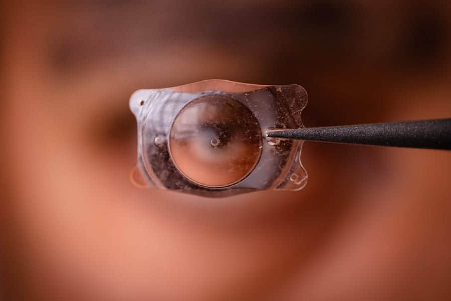 implants phakes chirurgie refractive dr thomas adam chirurgien ophtalmologue specialiste chirurgie refractive keratocone la reunion