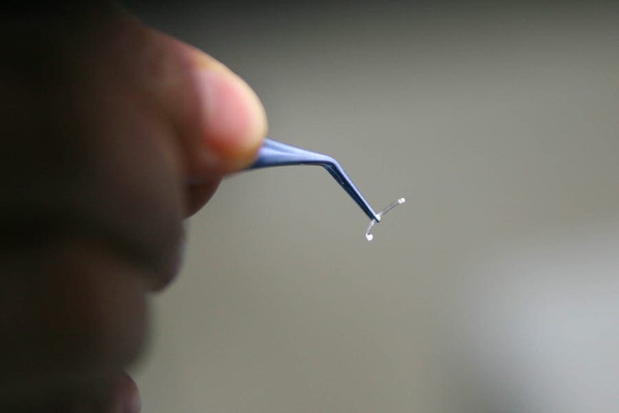 anneaux intracorneens thomas adam chirurgien ophtalmologue specialiste chirurgie refractive keratocone la reunion