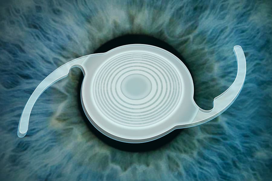 implant multifocal prelex dr thomas adam chirurgien ophtalmologue specialiste chirurgie refractive keratocone la reunion